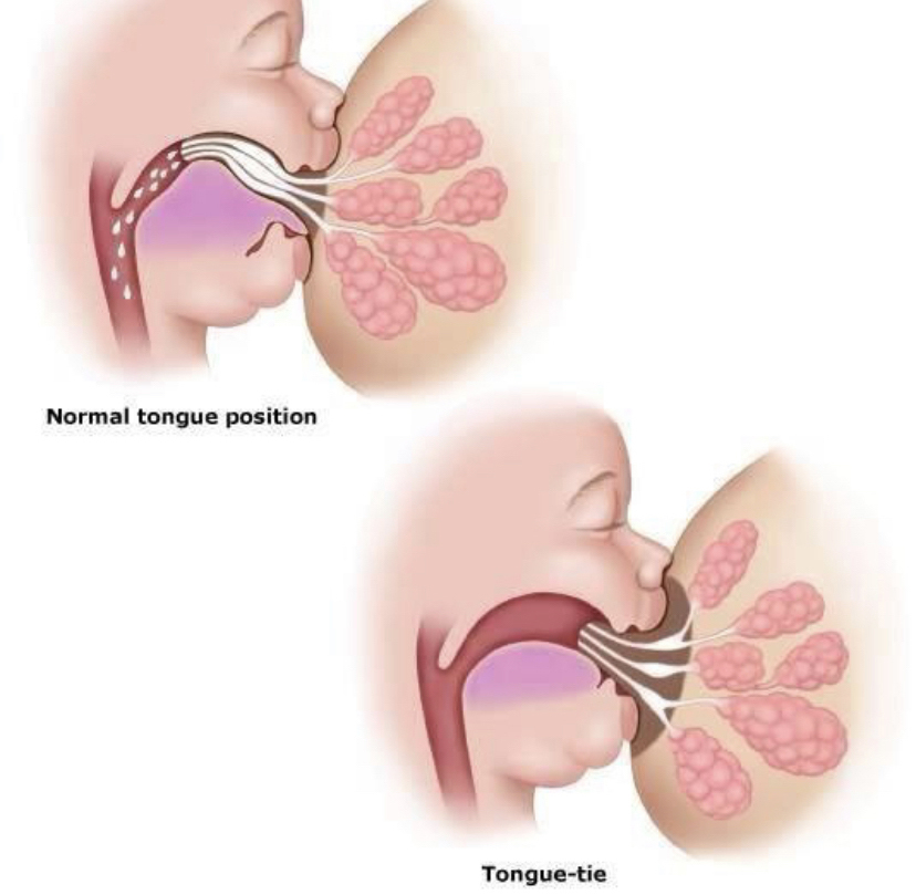 graphic of a baby with a tongue tie or a lip tie while baby is breastfeeding